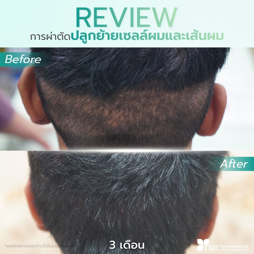 FUE Hair Transplant Review