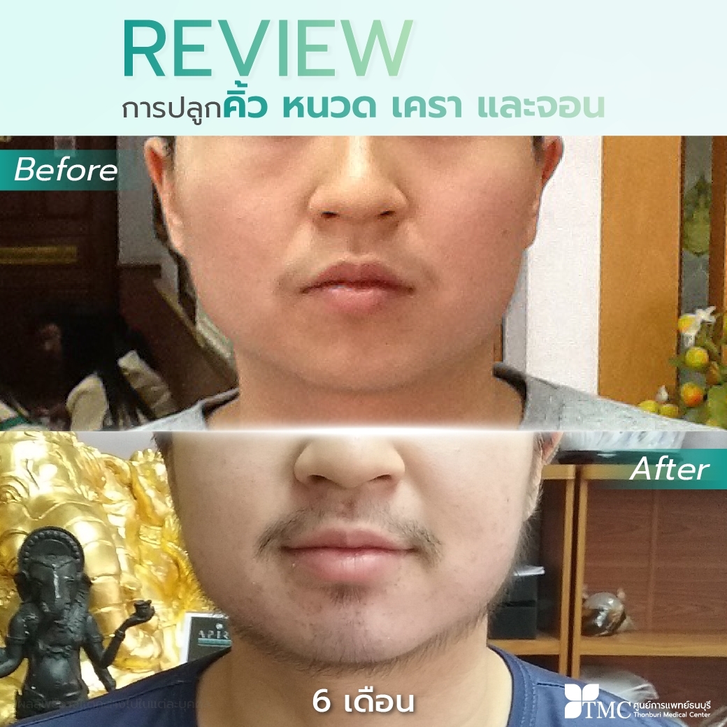 Face and Body Hair Growth Review