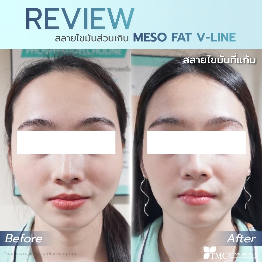 Review Meso Fat V-Line