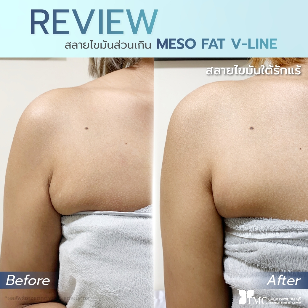 Review Meso Fat V-Line