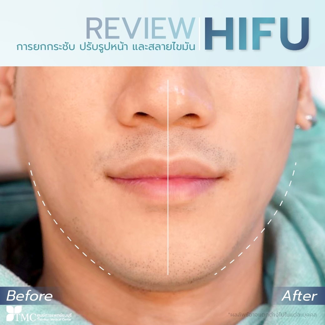 Review HIFU RF-lift