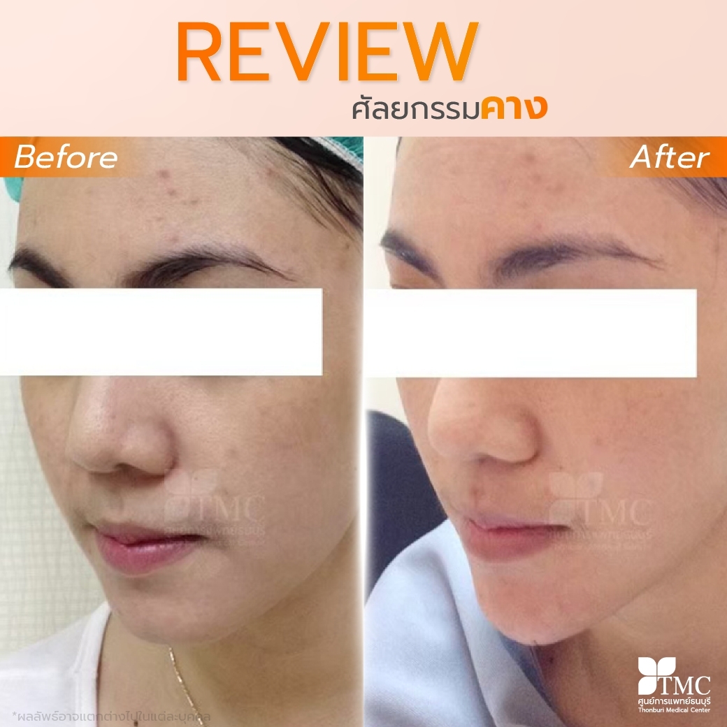Review - Chin Surgery