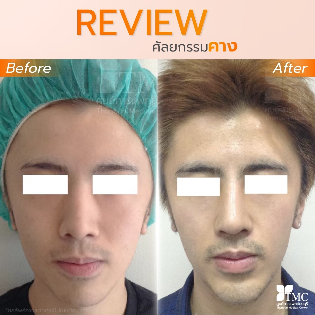 Review - Chin Surgery