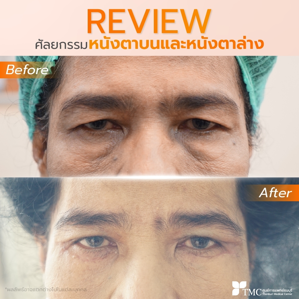 Review - Eye Surgery