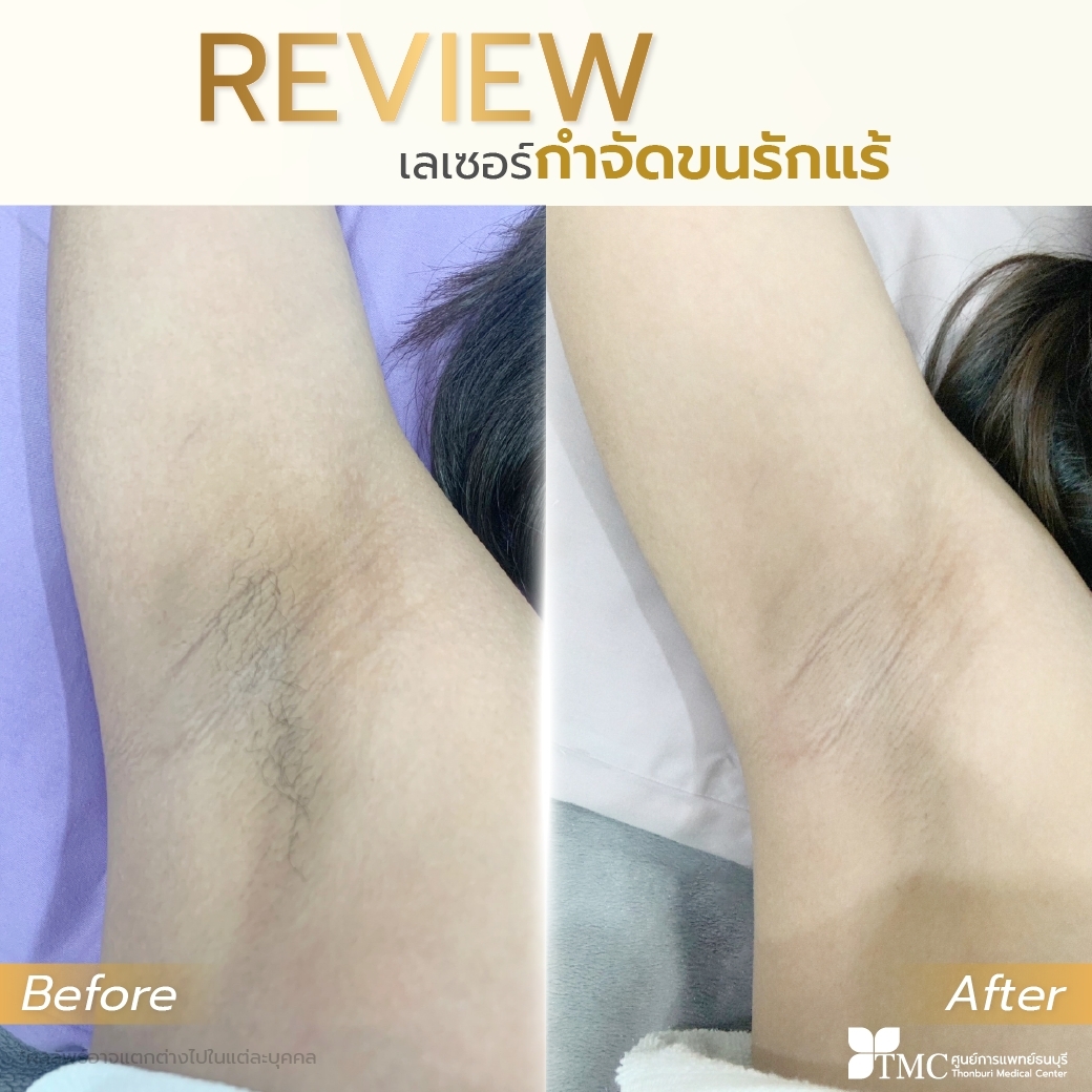 Hair Laser Removal Review