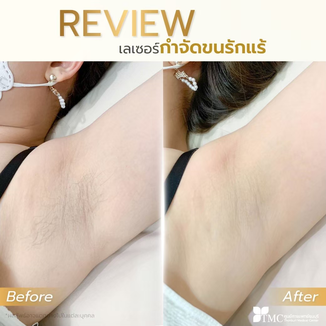 Hair Laser Removal Review