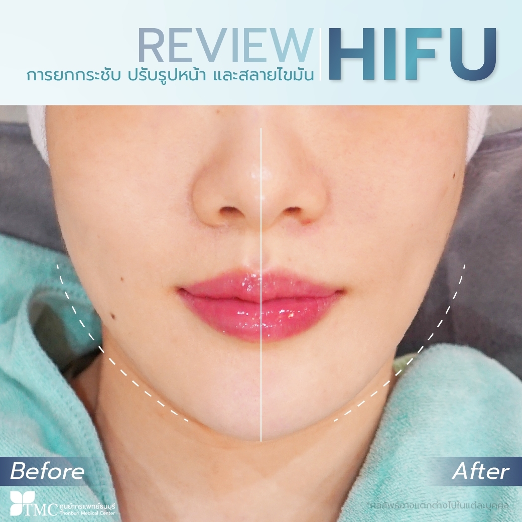 Review HIFU RF-lift