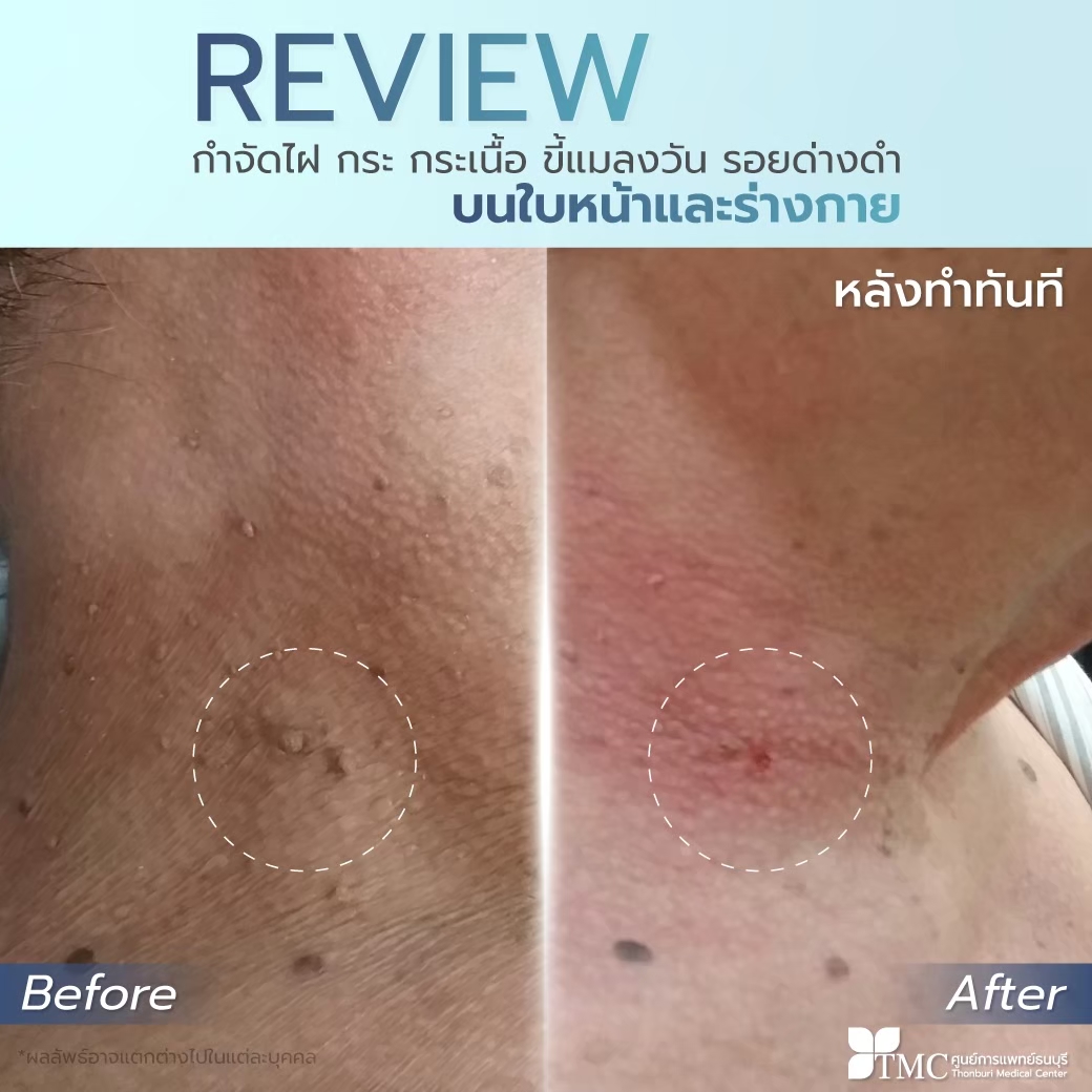 Review Mole Removal