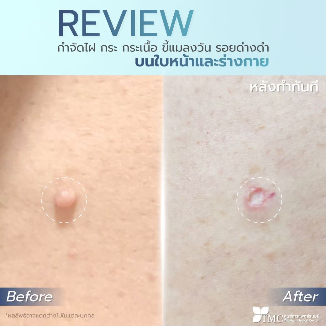 Review Mole Removal