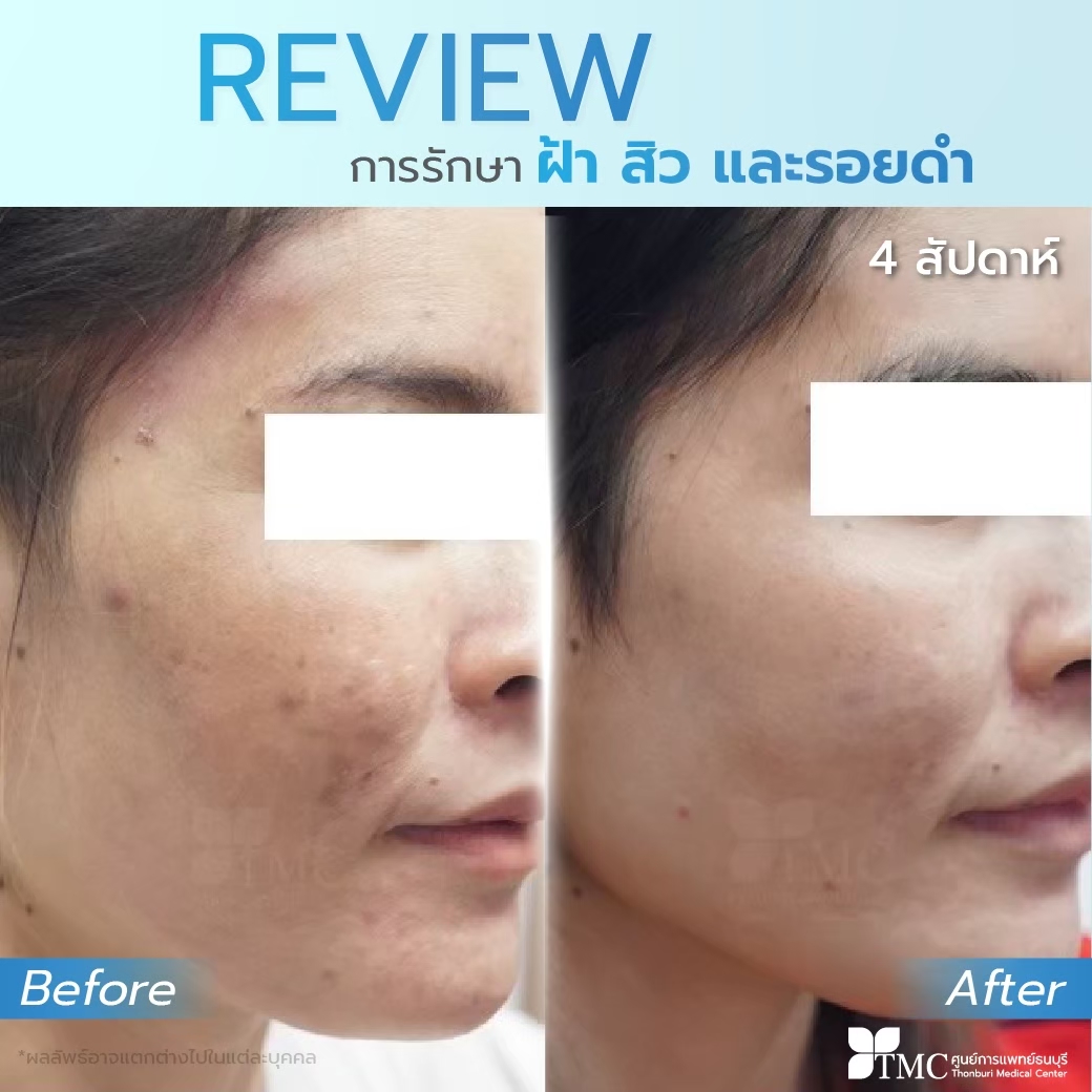 Review - Acne Treatment Program