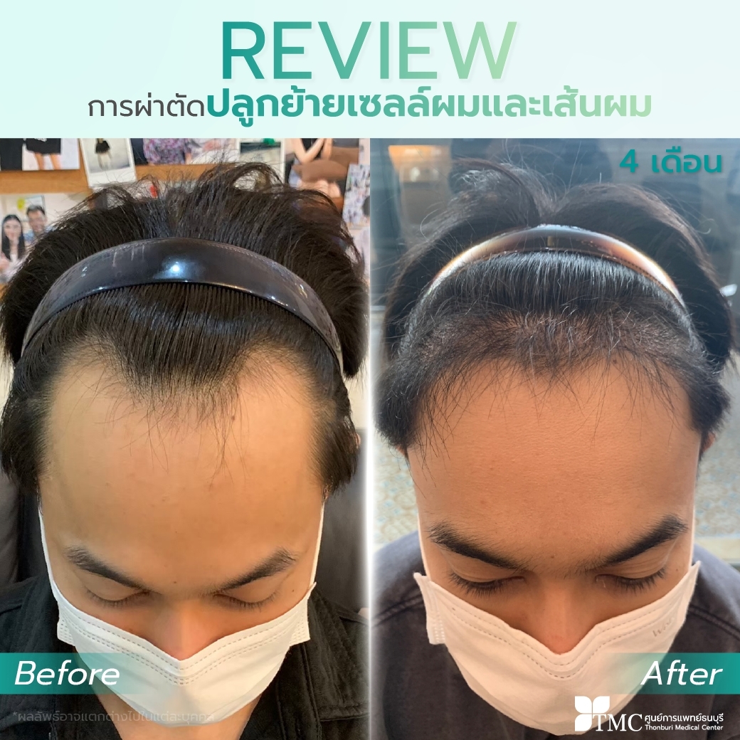 FUE Hair Transplant Review