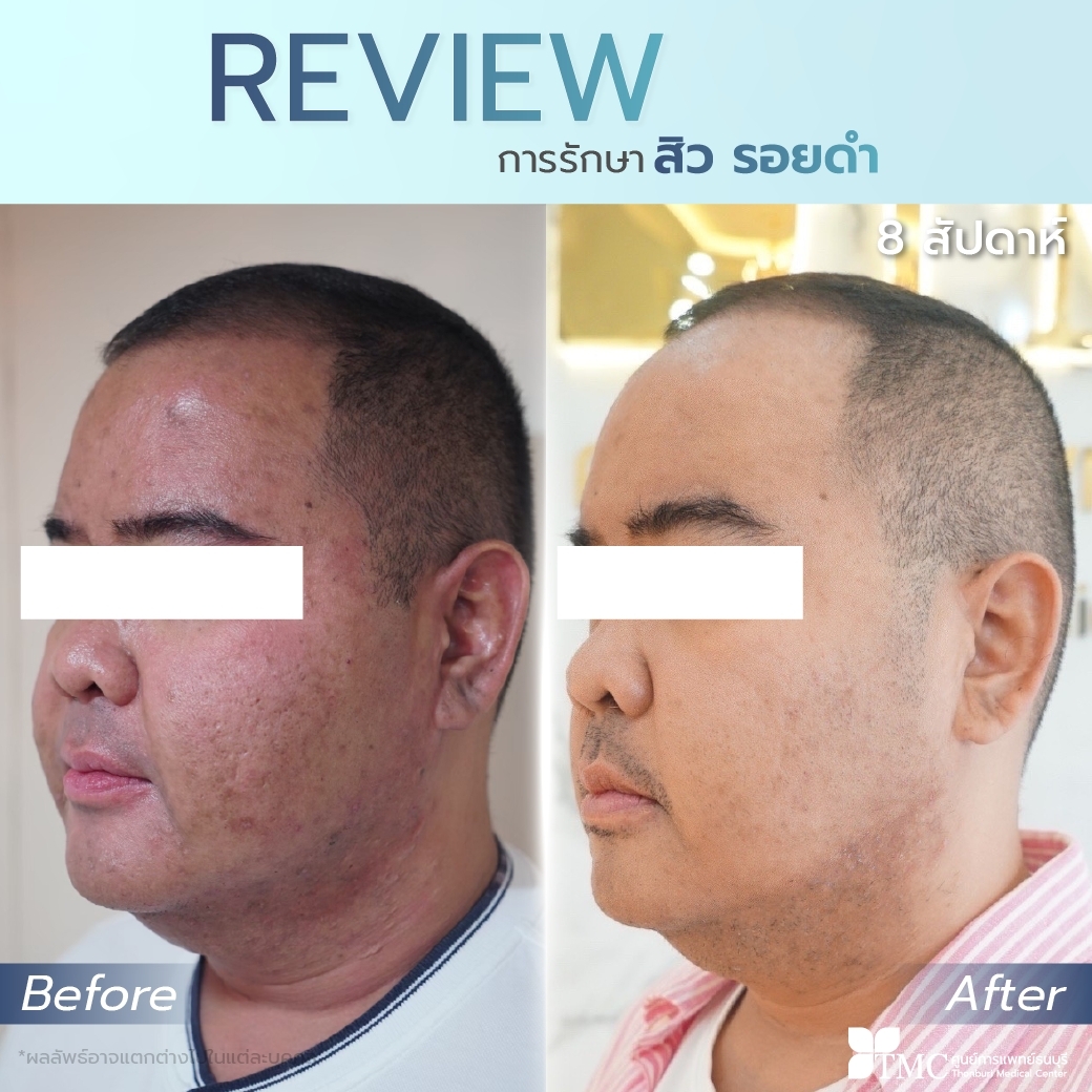 Review - Acne Treatment Program