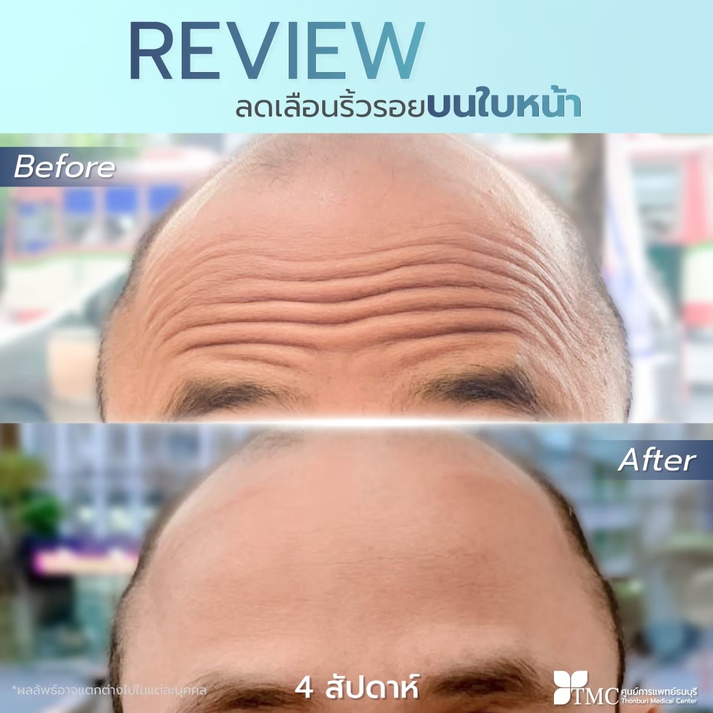 Botox Review